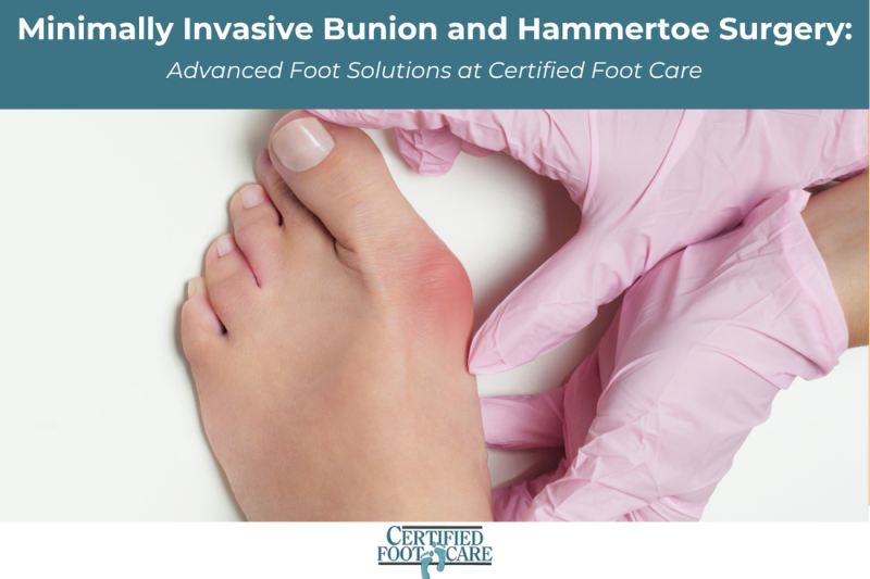 Minimally Invasive Bunion and Hammertoe Surgery Advanced Foot Solutions at Certified Foot Care